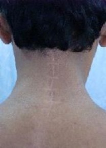 Không di lệch CÚI NGỬA Tầm vận động CSC bình thường XOAY CƠ CỔ BÌNH THƯỜNG 11