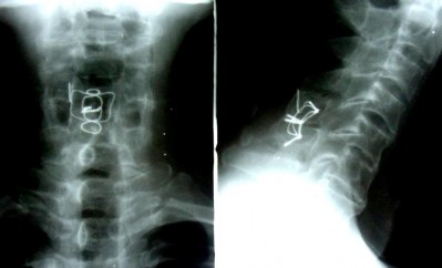 THẲNG NGHIÊNG NGỬA CÚI Sau mổ 7 năm tình trạng chỉ KHX vẫn tốt Liền xương 2