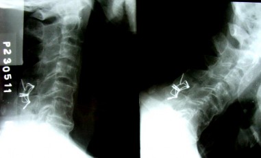 NGỬA CÚI Sau mổ 7 năm tình trạng chỉ KHX vẫn tốt Liền xương độ I Không di 3