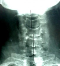 THẲNG NGHIÊNG Đường liên gai mất liên tục Bán trật xoay C4 C5 BÁN TRẬT MỎM 4