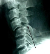 THẲNG NGHIÊNG Đường liên gai mất liên tục Bán trật xoay C4 C5 BÁN TRẬT MỎM 5