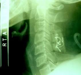 SAU MỔ 3 NĂM 14 10 05 THẲNG NGHIÊNG Liền xương loại I Tái tạo đường cong sinh 6