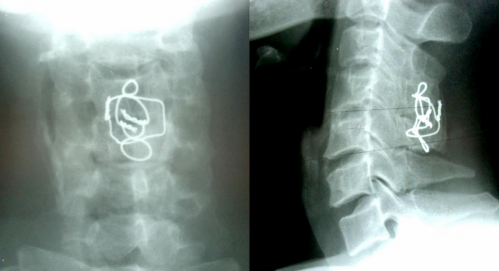 SAU MỔ 9 NĂM 27 5 2011 CÚI NGỬA Chỉ KHX vẫn tốt Liền xương tốt Cúi –ngửa 7