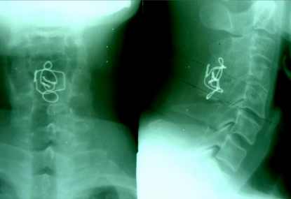 CÚI NGỬA Chỉ KHX vẫn tốt Liền xương tốt Cúi –ngửa không di lệch CÚI NGỬA 8