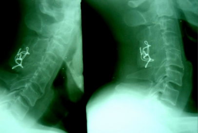 Chỉ KHX vẫn tốt Liền xương tốt Cúi –ngửa không di lệch CÚI NGỬA Tầm vận 9