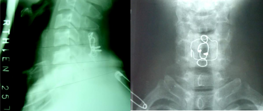 SAU MỔ 8 NĂM 4 5 2011 THẲNG NGHIÊNG NGỬA CÚI Liền xương độ I chỉ thép tốt cúi 1