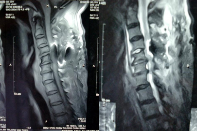 Đệm nghi ngờ có phù nề tủy và chèn ép phía sau do hình bị nhiễu nên không rõ 10