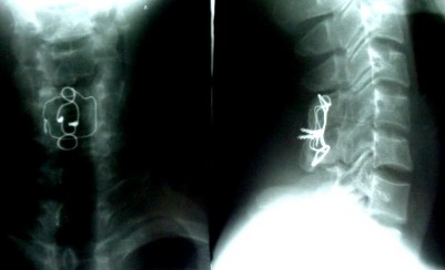 NGỬA CÚI Liền xương độ I chỉ thép tốt cúi – ngửa không di lệch thứ phát 2