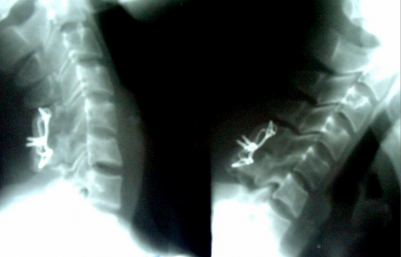 Liền xương độ I chỉ thép tốt cúi – ngửa không di lệch thứ phát HÌNH PHÔ 3