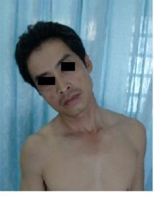 Trường hợp 4 Họ tên Trương Văn Th Tuổi 1938 Phái Nam Địa chỉ Tây Sơn Tây Vinh 6