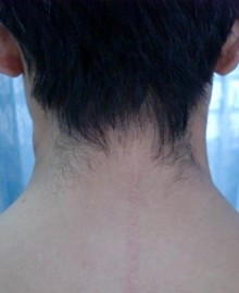 Trường hợp 4 Họ tên Trương Văn Th Tuổi 1938 Phái Nam Địa chỉ Tây Sơn Tây Vinh 7