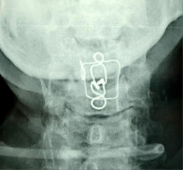 MRI SAU MỔ không thấy thoát vị đĩa đệm nghi ngờ có phù nề tủy và chèn ép 8