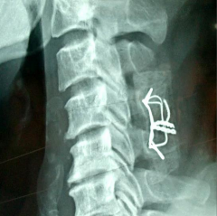 MRI SAU MỔ không thấy thoát vị đĩa đệm nghi ngờ có phù nề tủy và chèn ép 9
