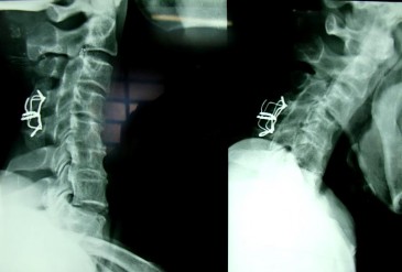 Vận động CSC bị hạn chế PHỤC HỒI VẬN ĐỘNG TAY CHÂN Tay P phục hồi cơ 2