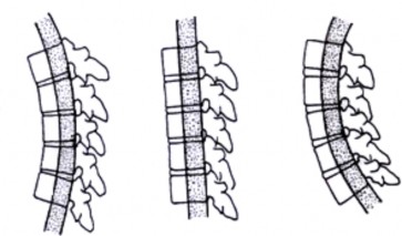 Hình 1 11A Cột giữa của Denis Hình 1 11B Ba cột của Denis Nguồn Denis 1983 Spine 8 59 11