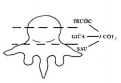 Hình 1 11A Cột giữa của Denis Hình 1 11B Ba cột của Denis Nguồn Denis 1983 Spine 8 59 12