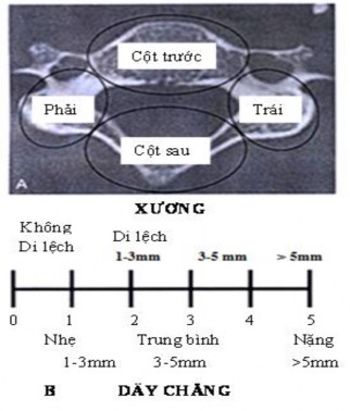 Hình 1 12 Thuyết 4 cột và cách tính điểm của Moore Nguồn Timothy 2006 Spine 31 113 13