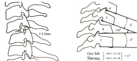 Hình 1 13 Tiêu chuẩn mất vững di lệch 3 5mm Hình 1 14 Gập góc 11 0 Nguồn White 1975 14