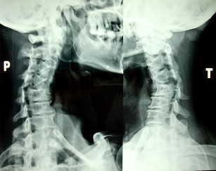 Hình 1 28 X quang chéo 3 4P và 3 4T Hình 1 29 X quang cắt lớp điện toán CSC thấp 14
