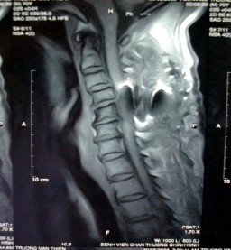 Hình 1 30 Cộng hưởng từ hạt nhân CSC 1 3 SƠ LƯỢC LỊCH SỬ PHẪU THUẬT CHẤN 16
