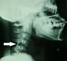 Hình 1 25 Bán trật 2 mỏm khớp C4 C5 mũi tên chỉ mỏm khớp dưới của C4 còn 5