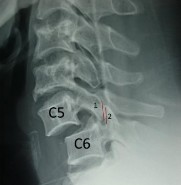 Hình 1 26 Trật 2 mỏm khớp 1 mỏm khớp trên của C6 nằm sau 2 mỏm khớp dưới 7