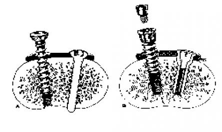 A: Nẹp Vít Hai Vỏ Xương; B: Nẹp Khóa Morcher. Nguồn : Leventhal (1998), Campell’S Operative Orthopeadics
