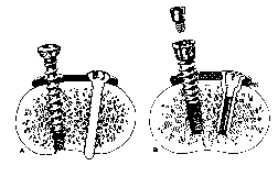 Các tác giả thấy rõ rằng sự lỏng vít xảy ra ở 2 nơi một là chỗ tiếp xúc 1