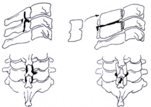Buộc chỉ mỏm gai và hàn xương bằng 2 mảnh xương mào chậu được cố định 10
