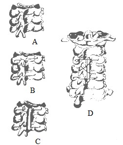 Hình 1 39 Phương pháp Omar néo ép xuyên 2 kim Kirschner Nguồn Omar 1995 Spine 11 92 A 11