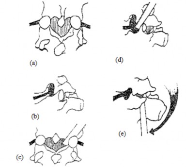 Hình 1 40 Cách nắn khớp hở kiểu bẩy vỏ xe Nguồn Cone Turner J B J S 19 1937 12
