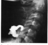 Hình 1 32 Kẹp móc Halifax ép bản sống Nguồn Renn 1984 Neurosurgery 3 99 Jeanneret 1991 3