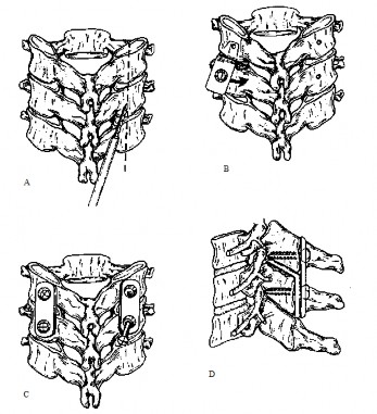 Hình 1 33 Phương pháp Roy Camille Nguồn Roy Camille 1988 Sixièmes journées d’ortopedie 4