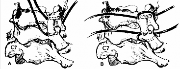 Hình 1 37 Phương pháp Stauffer hai sợi chỉ Nguồn Stauffer 1996 Fractures in Adults 112 9