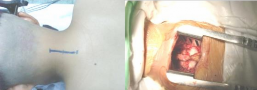 Hình 2 43 Đường rạch da Hình 2 44 Bộc lộ ổ gãy lộ 2 mặt khớp Nguồn từ tác 4