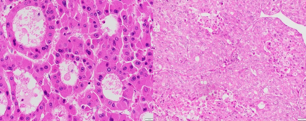 A B Ảnh 3 1 A UTBMTBG thể giả tuyến với các tế bào u sắp xếp dạng giả tuyến 1