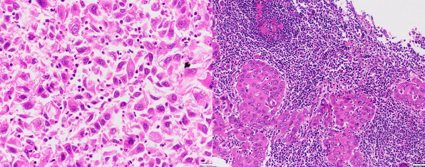 A B Ảnh 3 2 UTBMTBG đa hình thái không biệt hóa A HE x 200 mã số 4257 18 UTBMTBG típ 2