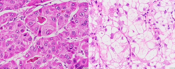 A B Ảnh 3 3 UTBMTBG thể điển hình với các tế bào hình đa diện bào tương dạng 3