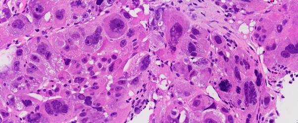 A B Ảnh 3 6 UTBMTBG thể đa hình với các tế bào u đa dạng về kích thước có 4