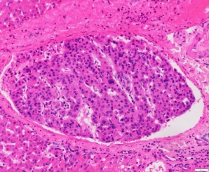 A B Ảnh 3 7 UTBMTBG xâm nhập mạch A HE x 100 mã số 1073 18 B HE x 200 mã số SU 9608 3 1