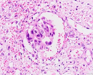 A B Ảnh 3 7 UTBMTBG xâm nhập mạch A HE x 100 mã số 1073 18 B HE x 200 mã số SU 9608 3 2