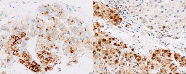 A B Ảnh 3 9 Mô ung thư dương tính với dấu ấn GPC 3 A và dấu ấn HSP 70 B x 100 mã 1