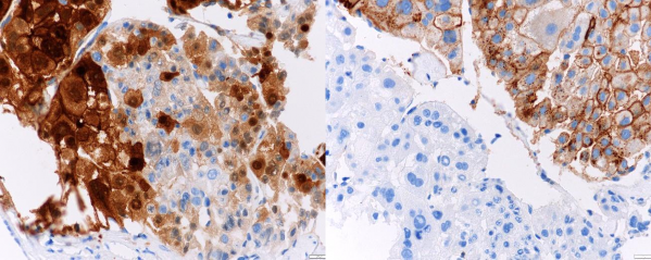 A B Ảnh 3 10 Mô ung thư dương tính với dấu ấn Arginase 1 A và dấu ấn GPC 3 B x 2