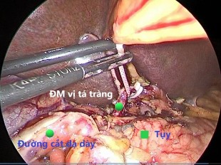 Hình 4 1 Cắt động mạch vị tá tràng Nguồn BN Đỗ Văn M 67 tuổi Mã BA 19 03 00991 1