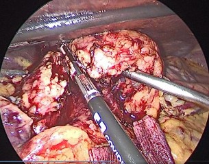 Hình 4 2 Cắt nhu mô tụy Nguồn BN Đỗ Văn M 67 tuổi Mã BA 19 03 00991 BM Chúng tôi 2