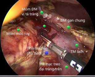 Hình 4 3 Cắt mạc treo và mỏm móc tụy Nguồn Nguyễn Thị T 38 T Mã BA 18 03 11308 BM 3
