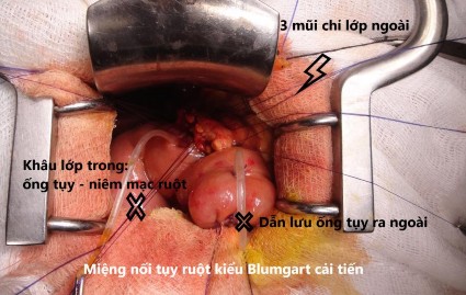 Hình 4 5 Miệng nối tụy – ruột kiểu Blumgart cải tiến Nguồn BN Đỗ Văn M 67T 1