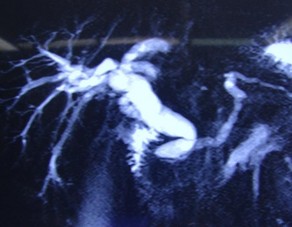 Ảnh 1 Cộng hưởng từ trước mổ Ảnh 2 C ắt ĐM vị tá tràng qua nội soi Ảnh 3 1