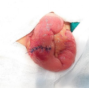 Ảnh 5 Cắt túi thừa Meckel Ảnh 6 Tế bào học UTBMT bóng Vater Mã số ST0449 nhuộm 10