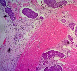 Ảnh 5 Cắt túi thừa Meckel Ảnh 6 Tế bào học UTBMT bóng Vater Mã số ST0449 nhuộm 11